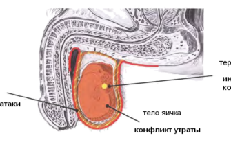 Рак яичка (тератома), абсцесс яичка, дермоидная киста яичка («опухоль-монстр»)