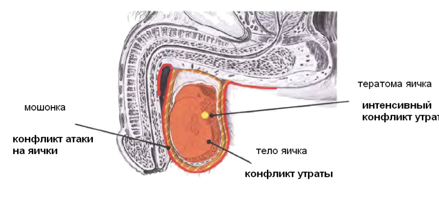 Рак яичка (тератома), абсцесс яичка, дермоидная киста яичка («опухоль-монстр»)