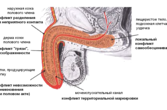 Уплотнение фиброзной ткани полового члена, деформация полового члена при эрекции (фибропластическая индурация, болезнь Пейрони).