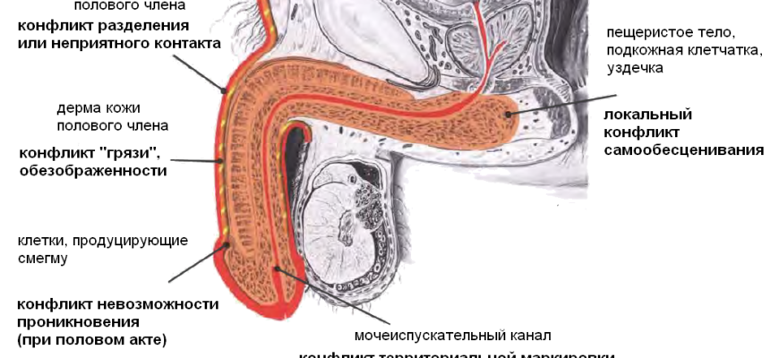 Уплотнение фиброзной ткани полового члена, деформация полового члена при эрекции (фибропластическая индурация, болезнь Пейрони).