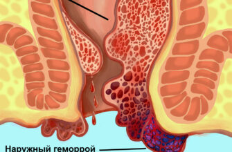 Наружный геморрой