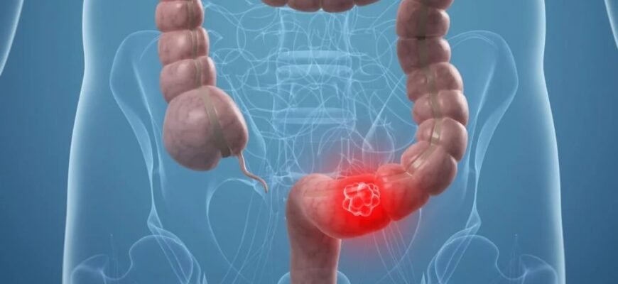 Рак толстого кишечника, полип толстого кишечника.