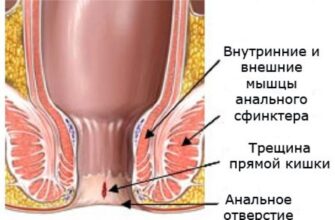 Случай из практики Олега Савицкого: Геморрой и боли в пояснице.