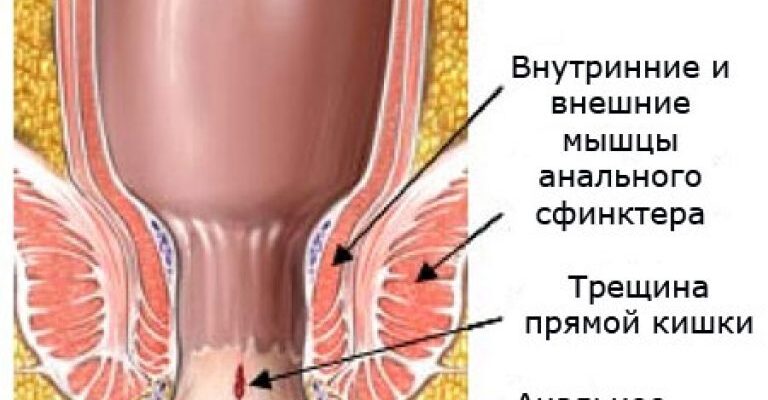 Спазмы сфинктера (тенезмы)