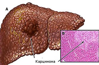 Рак печени (аденокарцинома), гепатоцеллюлярная карцинома.
