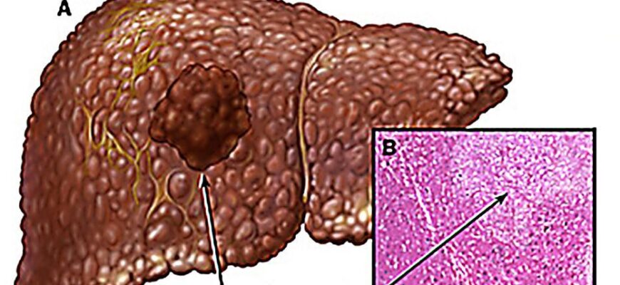 Рак печени (аденокарцинома), гепатоцеллюлярная карцинома.