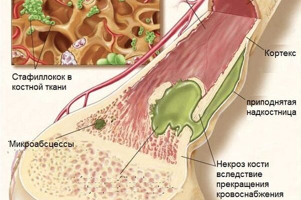 Разрушение тканей костного мозга (некроз костного мозга), замещение тканей костного мозга соединительной тканью (фиброз костного мозга, миелофиброз, остеомиелосклероз)