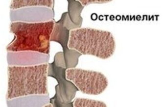 Воспаление костного мозга (остеомиелит)
