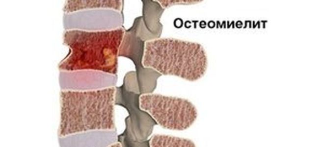 Воспаление костного мозга (остеомиелит)