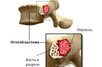 Рак кости (остеобластома, остеома, остеоидная остеома, саркома Юинга, остеосаркома)