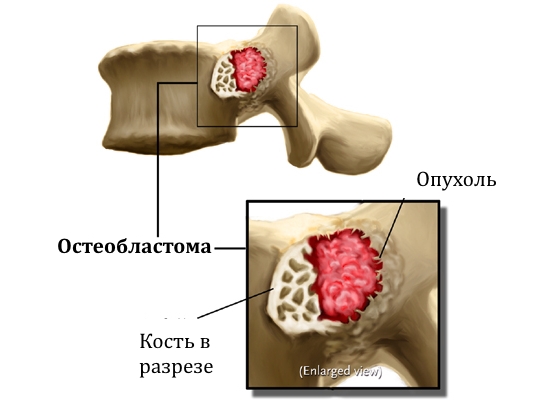 Рак кости (остеобластома, остеома, остеоидная остеома, саркома Юинга, остеосаркома)