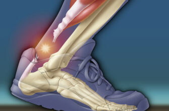 Воспаление и разрыв ахиллова сухожилия