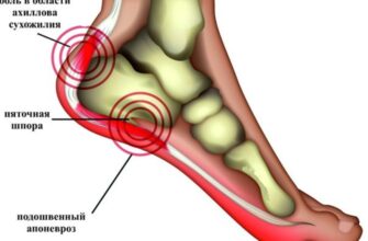 Плантарный фасцит («пяточная шпора»)