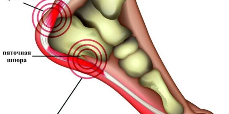 Плантарный фасцит («пяточная шпора»)