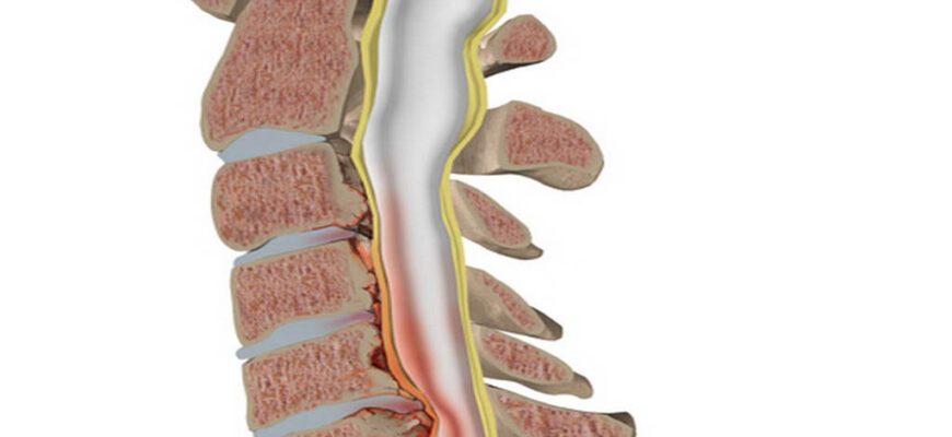 Сужение позвоночного канала (стеноз позвоночного канала)