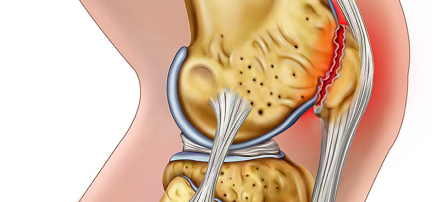 Разрыв мениска коленного сустава, крестообразный или боковой связки, хряща, разрушение коленного сустава