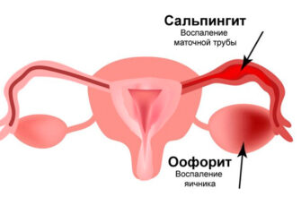Воспаление маточных труб (сальпингит, воспалительные заболевания органов малого таза)