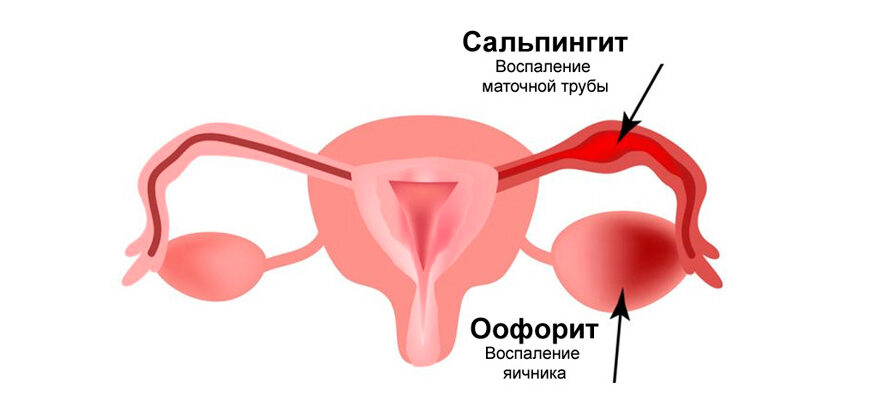 Интерстициальный рак яичника, сальпингоофорит, аднексит, низкий уровень эстрогена, нерегулярные месячные, задержанные менархе, аменорея, бесплодие, киста яичника.