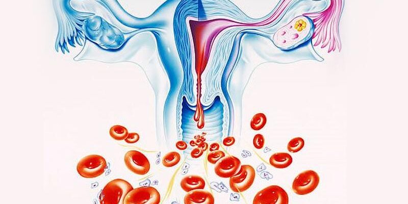 Кровотечение или слишком обильная менструация (гиперменорея)