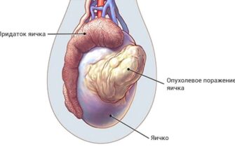 Рак яичка (карцинома, семинома, опухоль из клеток Лейдига и т.д)
