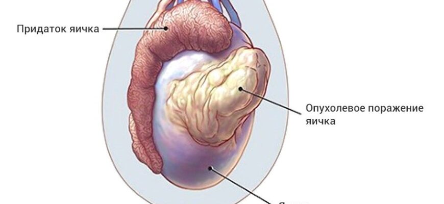 Рак яичка (карцинома, семинома, опухоль из клеток Лейдига и т.д)