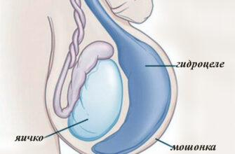 Гидроцеле (водянка яичка)