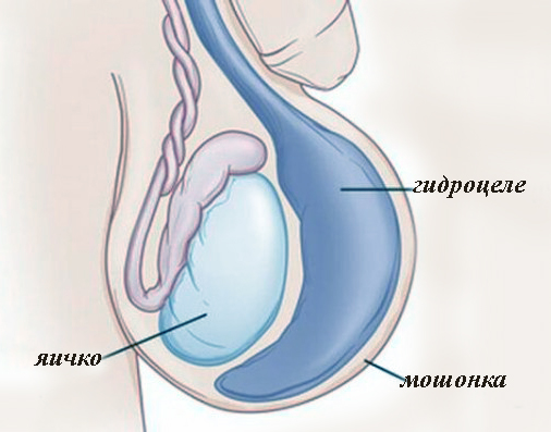 Гидроцеле (водянка яичка)